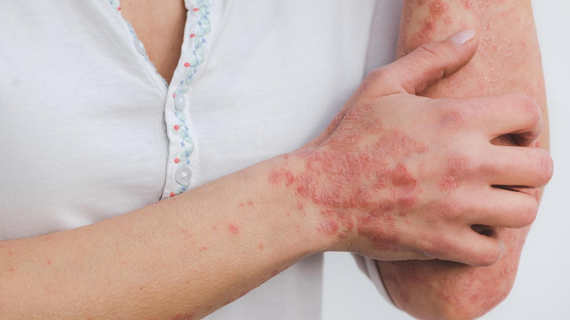Psoriasis