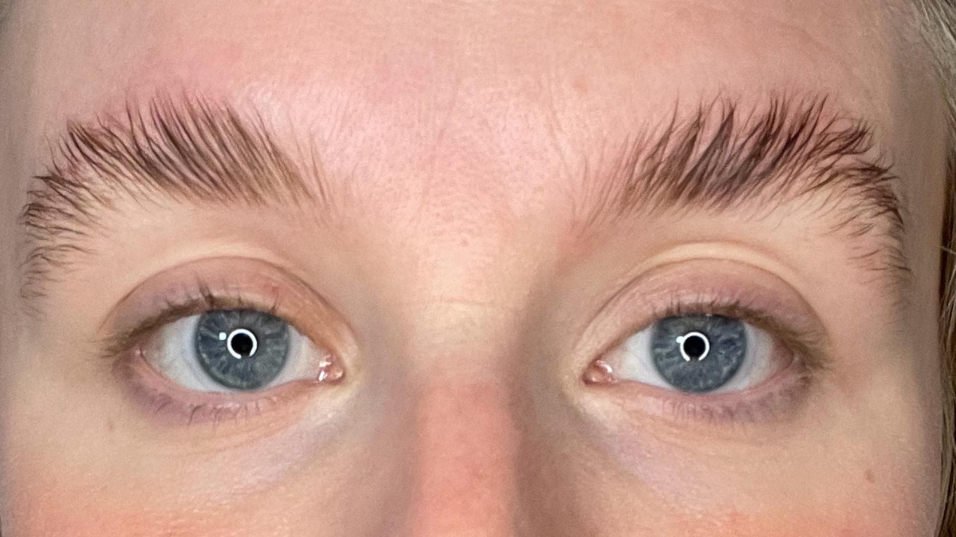 Fleeky-Brow-Lift Erfahrungen Ergebnis von einem Brow Lift