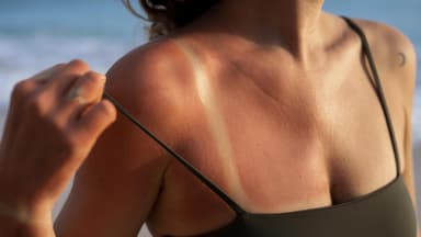 Frau mit Sonnenbrand