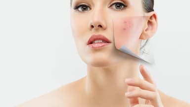 Rosacea