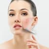 Rosacea