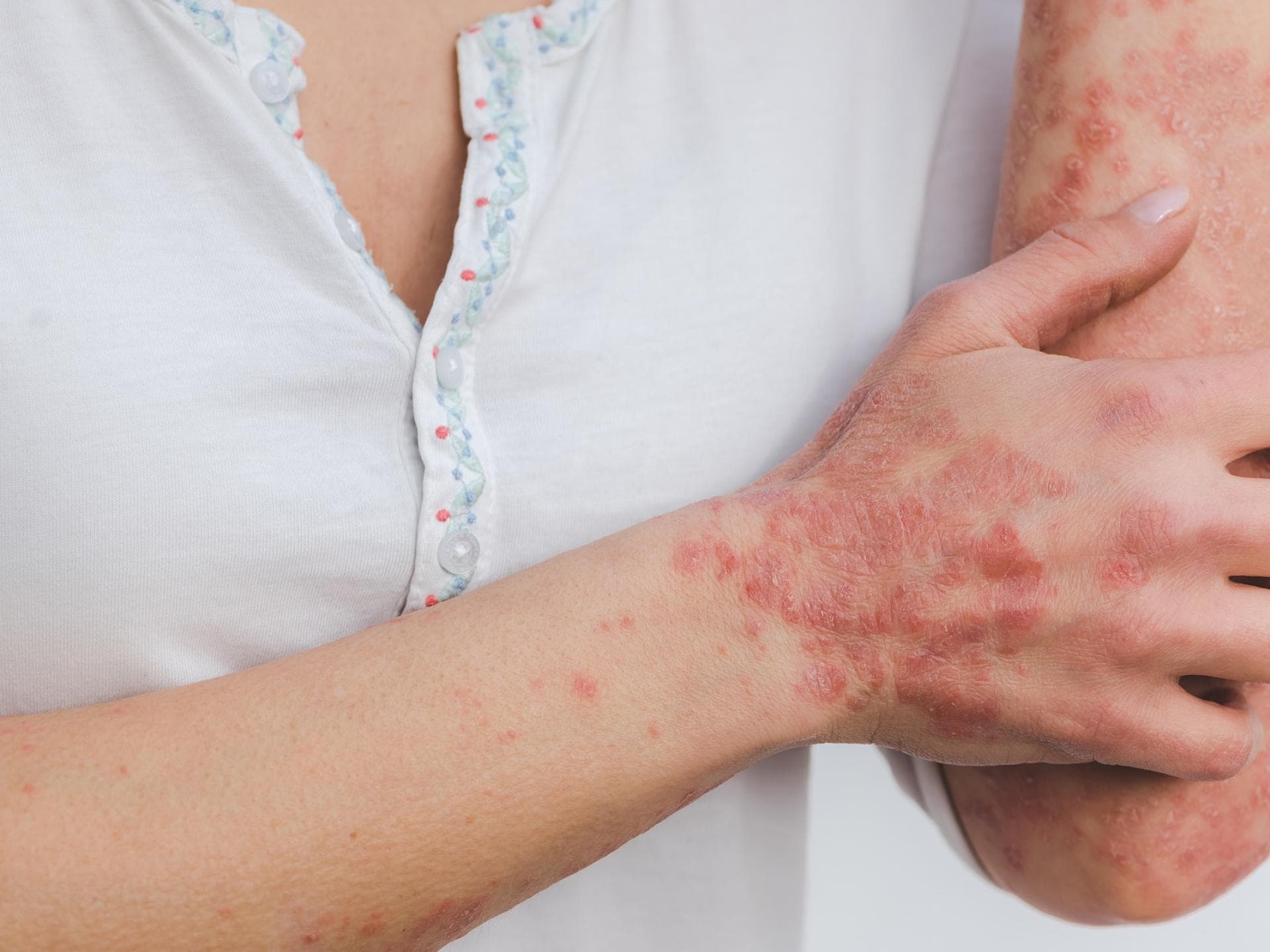Psoriasis