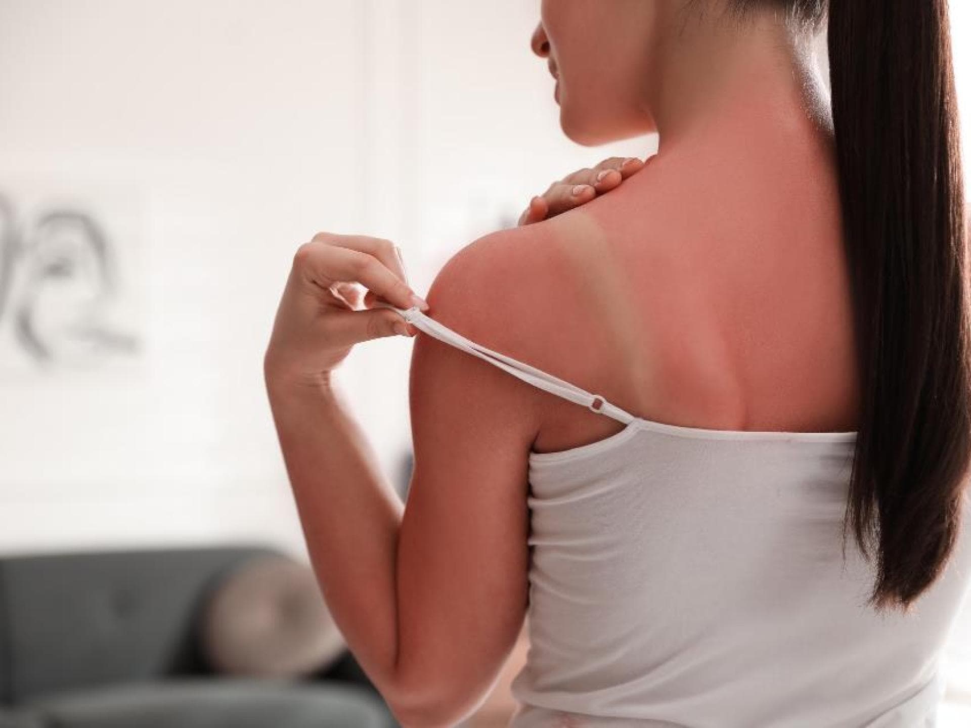 Sonnenbrand Sonnenbrand