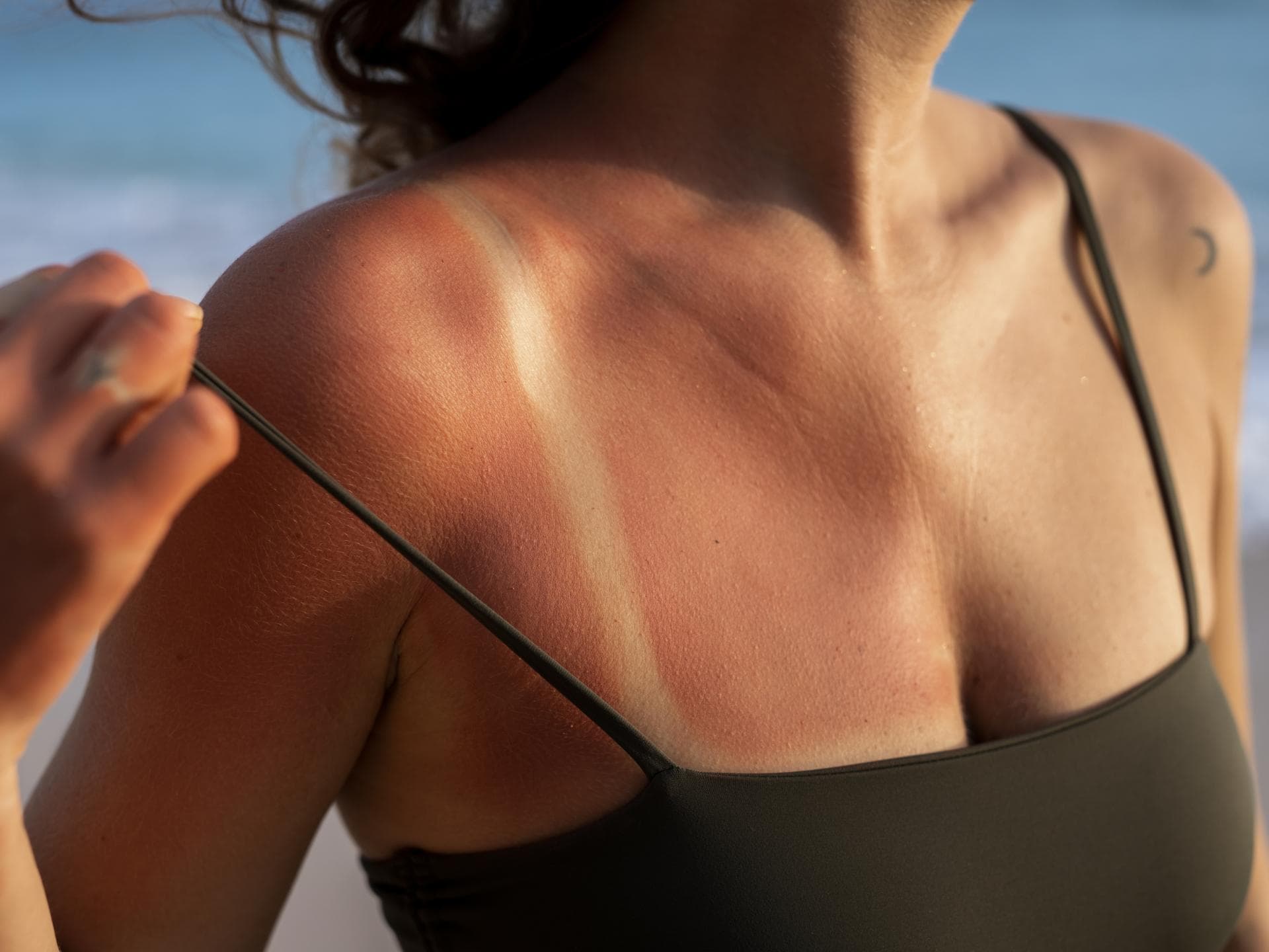 Sonnenbrand kühlen mit welchen Mitteln? Frau mit Sonnenbrand
