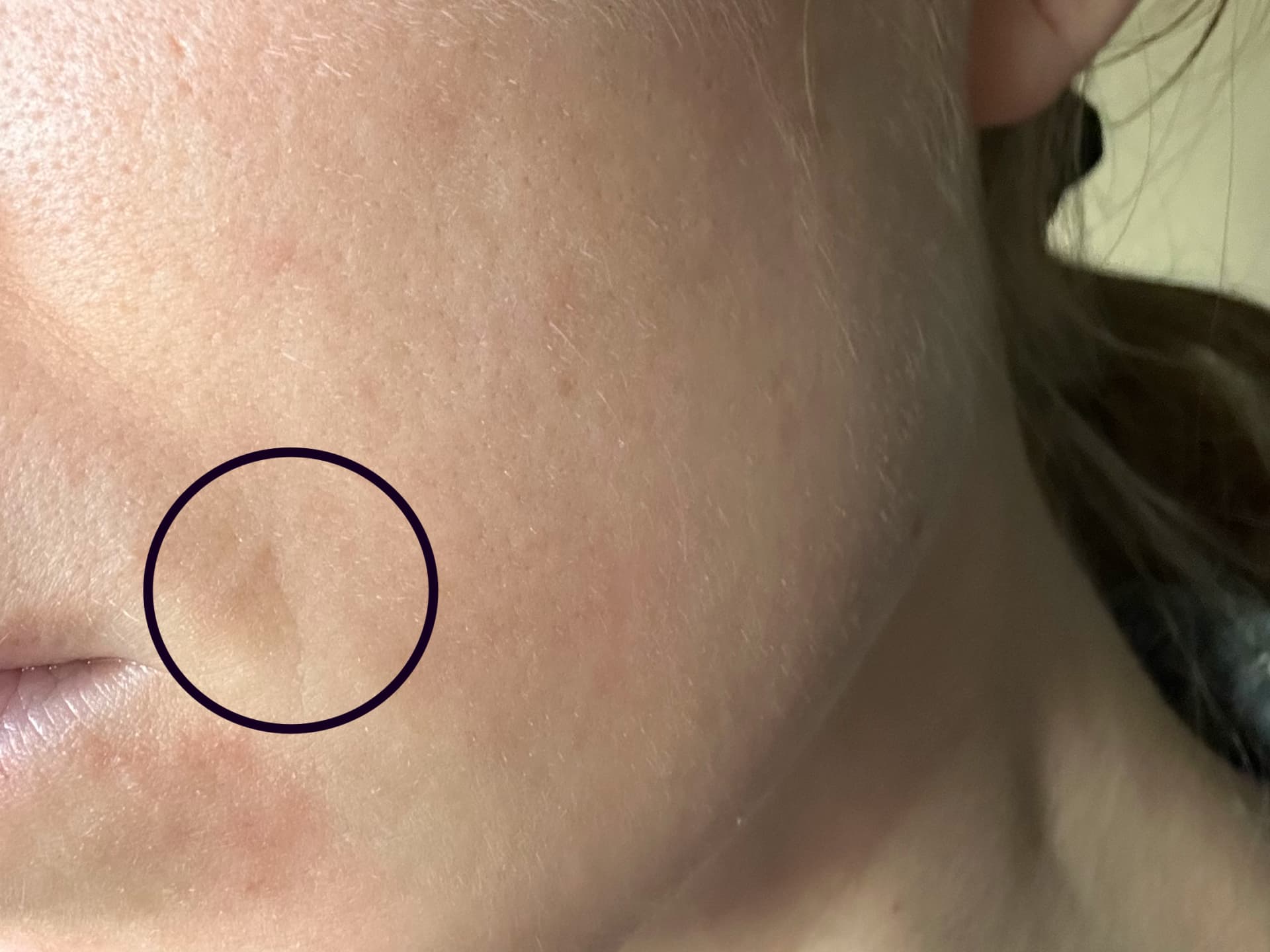 Currentbody LED-Maske Erfahrungen - Falte vorher - stark zu sehen