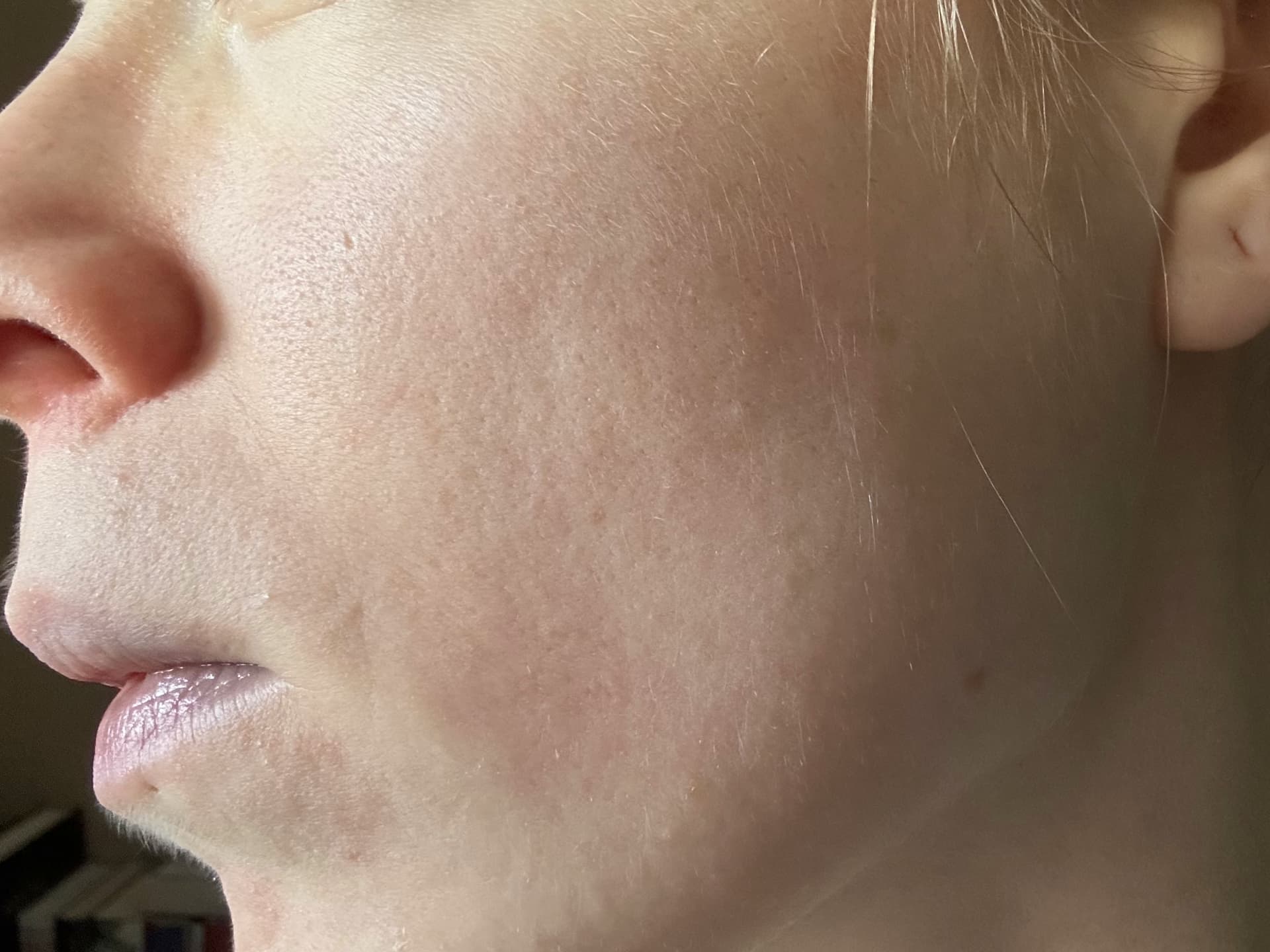 Currentbody LED-Maske Erfahrungen - meine Haut vorher