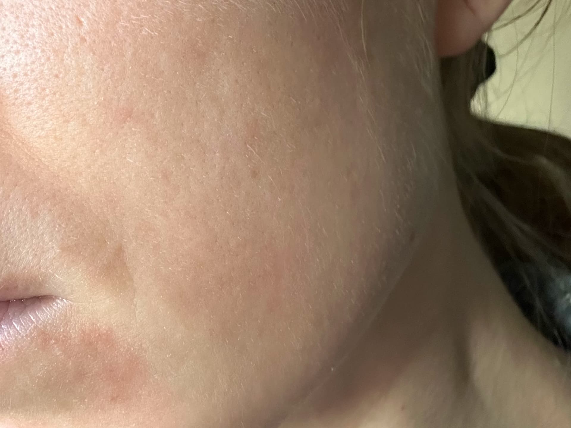 Currentbody LED-Maske Erfahrungen - meine Haut im Detail vorher