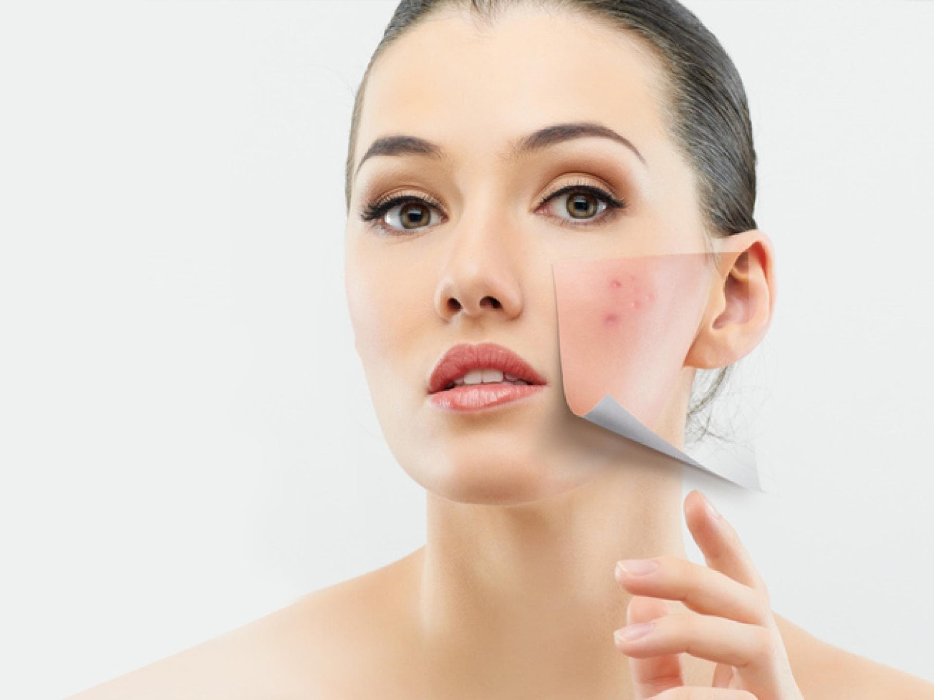 Rosacea